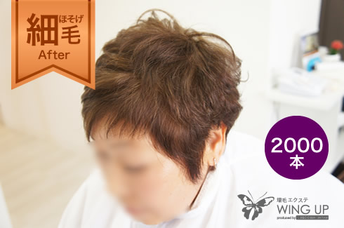 施術例その2（施術後）