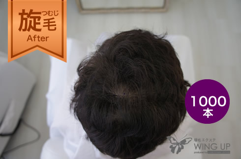 施術例その3（施術後）